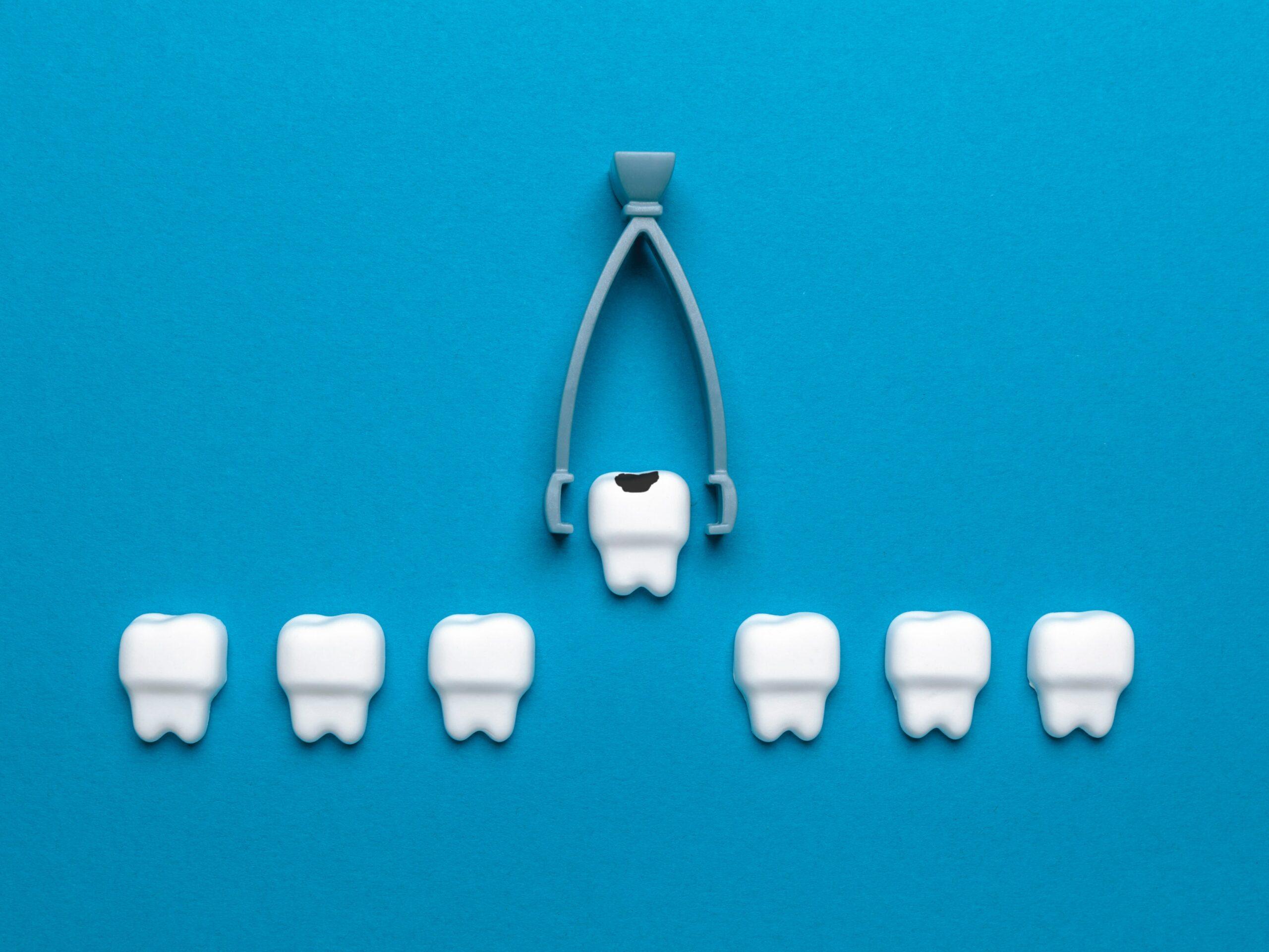 What Can You Expect After a Tooth Extraction?