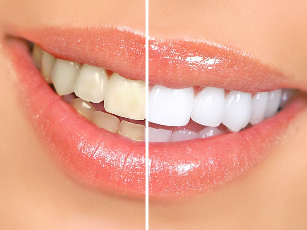 How Can Teeth Whitening Transform My Smile?