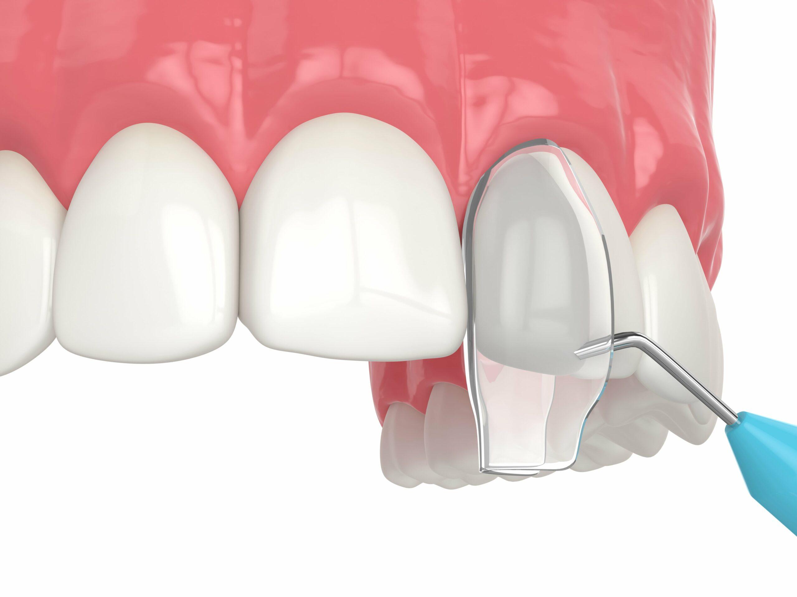 Cosmetic Bonding: A Pain-Free Solution for Flawless Smiles!