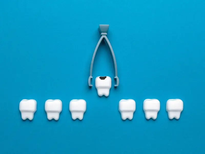 What Can You Expect After a Tooth Extraction?