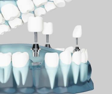 Dental Implants: Choosing the Best Implant Dentist in Shelby Township