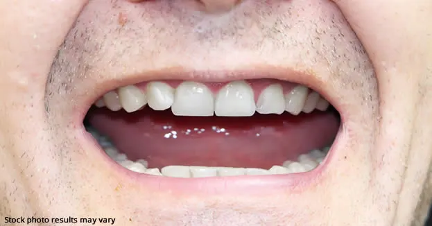 After full mouth restoration — restored healthy smile