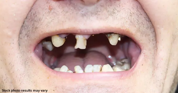 Full mouth restoration