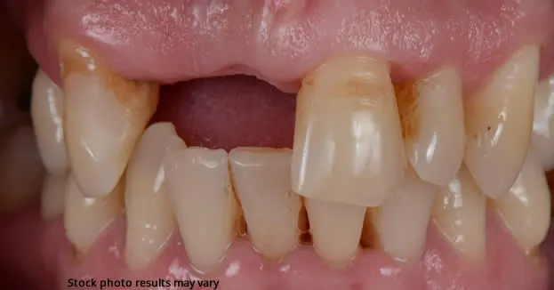 Before dental bridge — missing tooth