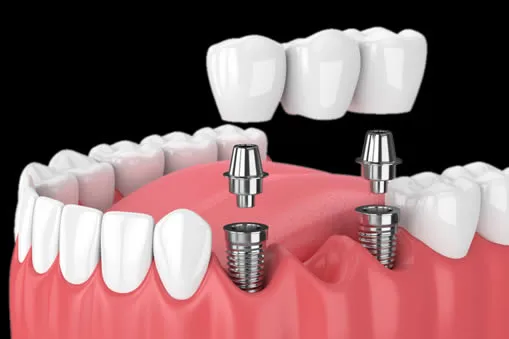 Implant supported bridge