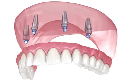 All-on-4 dental implants