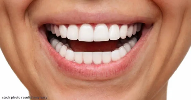 Porcelain veneers after treatment