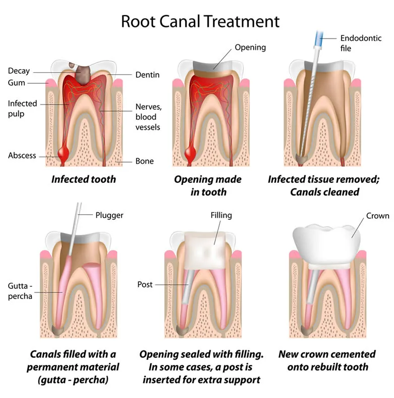 What is root canal therapy?