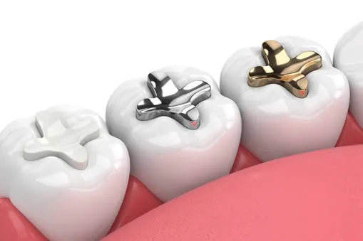 What are the different types of inlay and onlay?