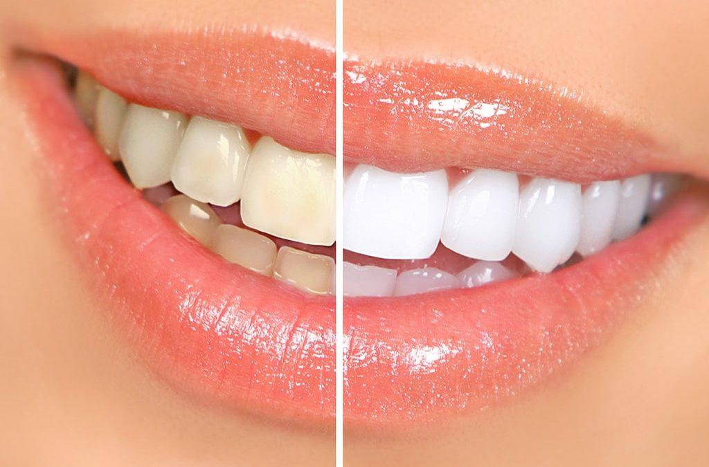 Teeth Whitening