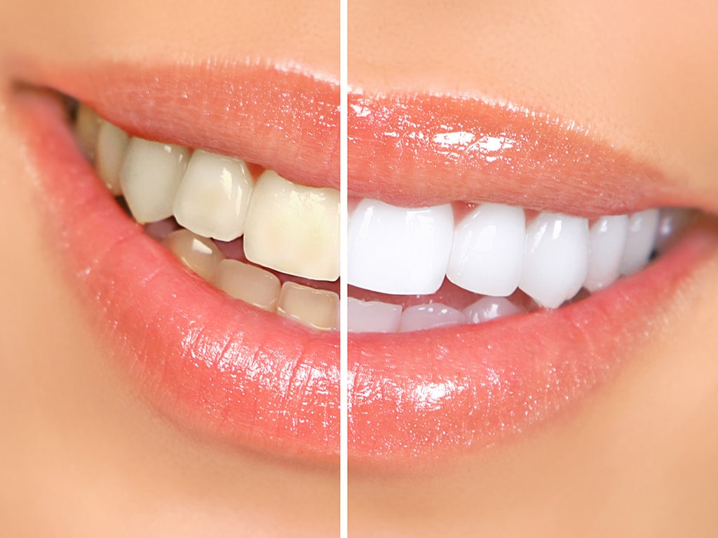 Teeth Whitening