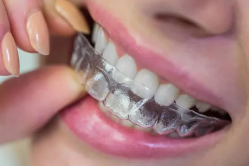 Reveal clear aligner on teeth