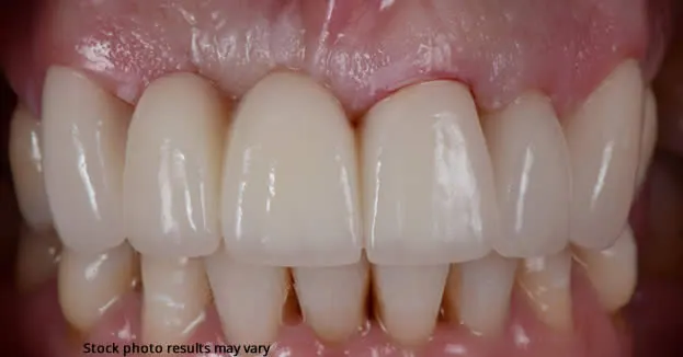 close up after dental bridge