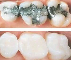 white fillings 1