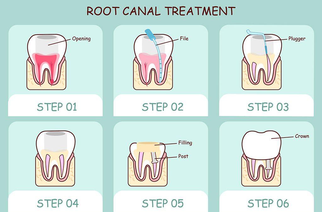 Do I Need a Root Canal?