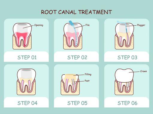 Do I Need a Root Canal?