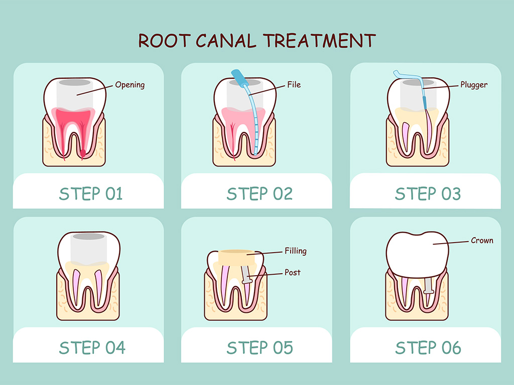 Do I Need a Root Canal?