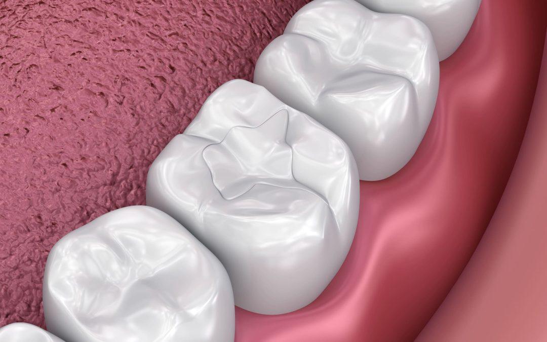 5 Benefits of Tooth-Colored Fillings