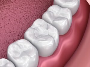 5 Benefits of Tooth-Colored Fillings