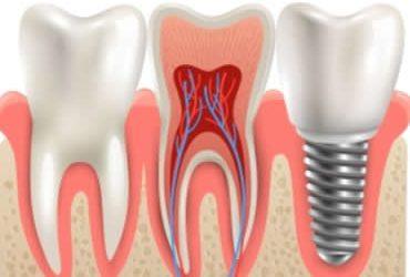 When to Choose Mini Dental Implants